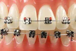 teeth clips teeth braces cost