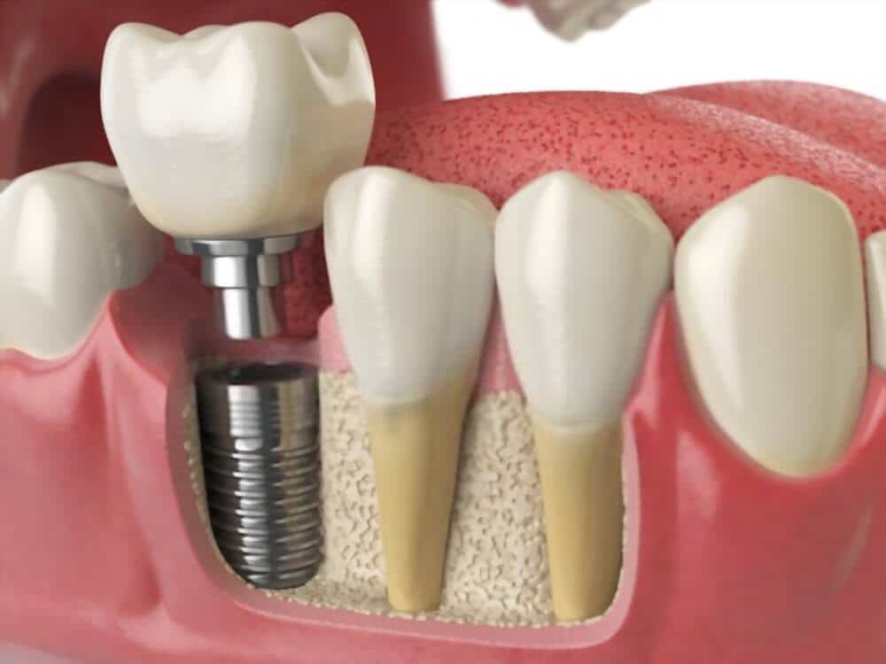 dental implants cost