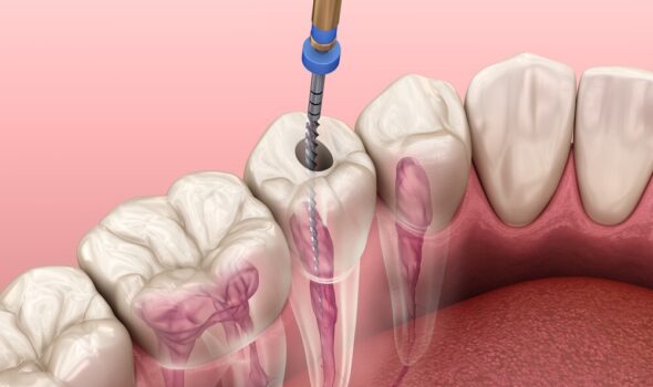 root canal treatment cost in kukatpally