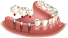 implant dentist in kukatpally at affordable cost