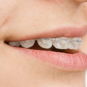 teeth clips