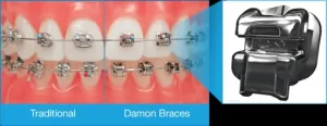 self ligating braces