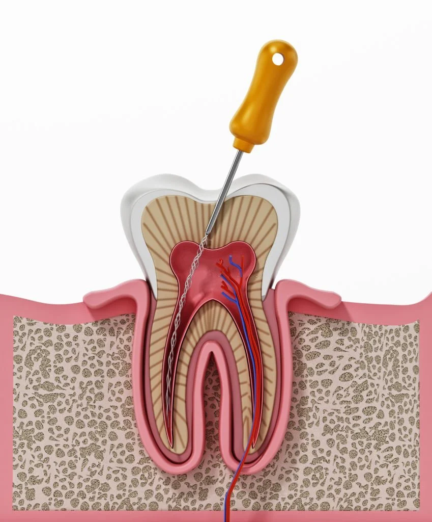 root canal cost in hyderabad