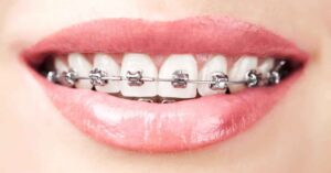 Self ligating braces