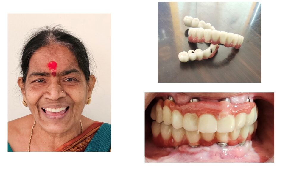 Dental Implants Kukatpally