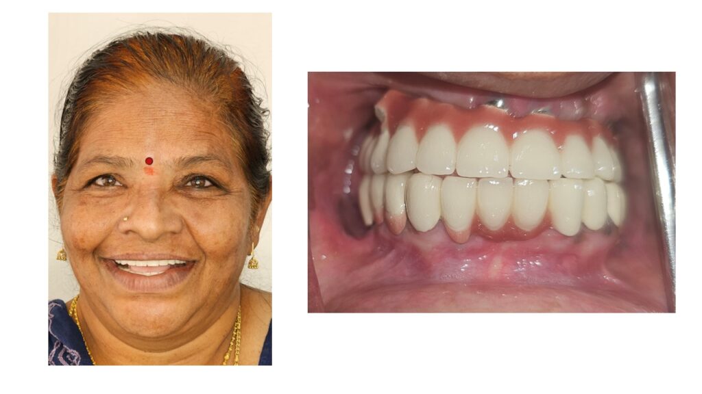 Dental implants