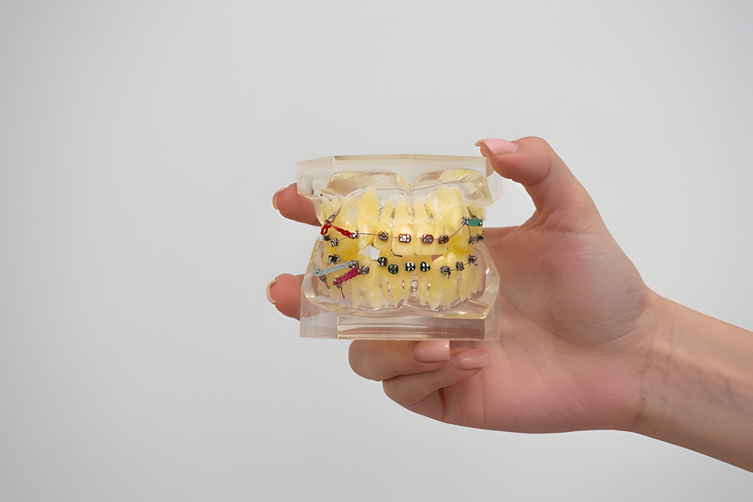 Teeth clips