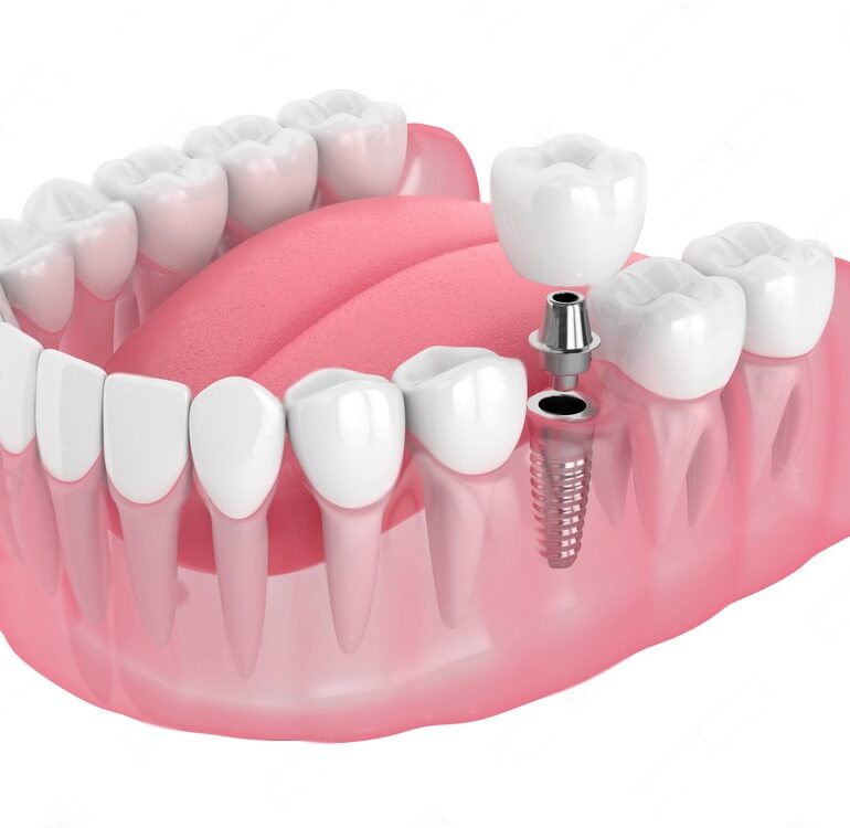 dental implants