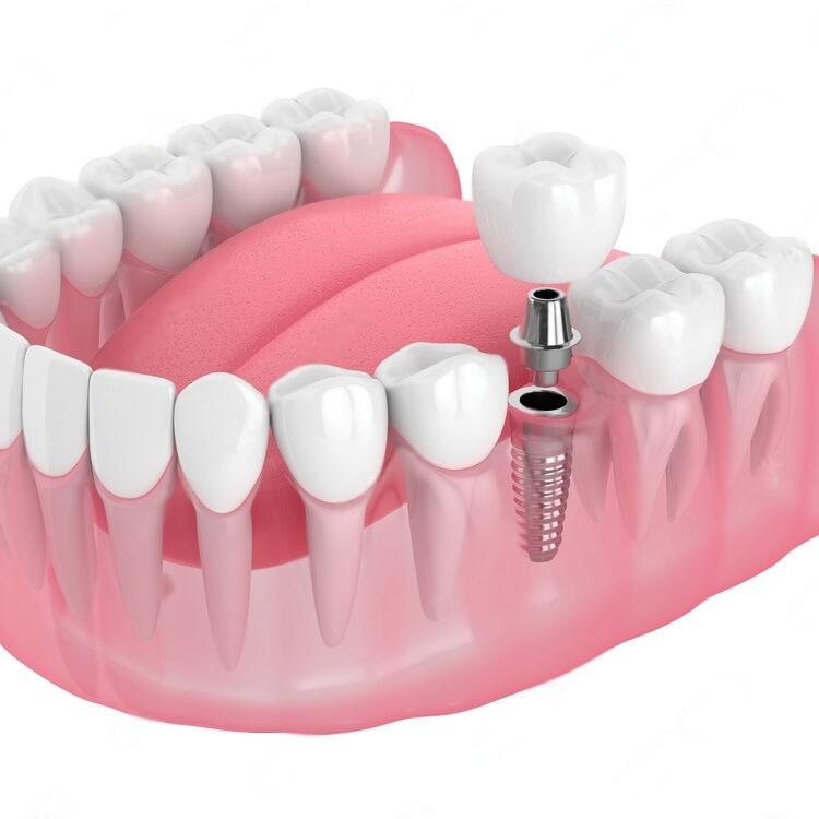 dental implants