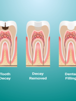 tooth filling cost