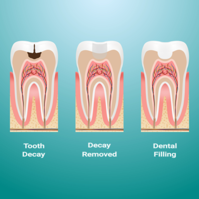 tooth filling cost