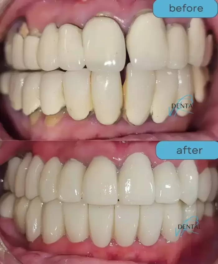 Zirconia crowns cost in India