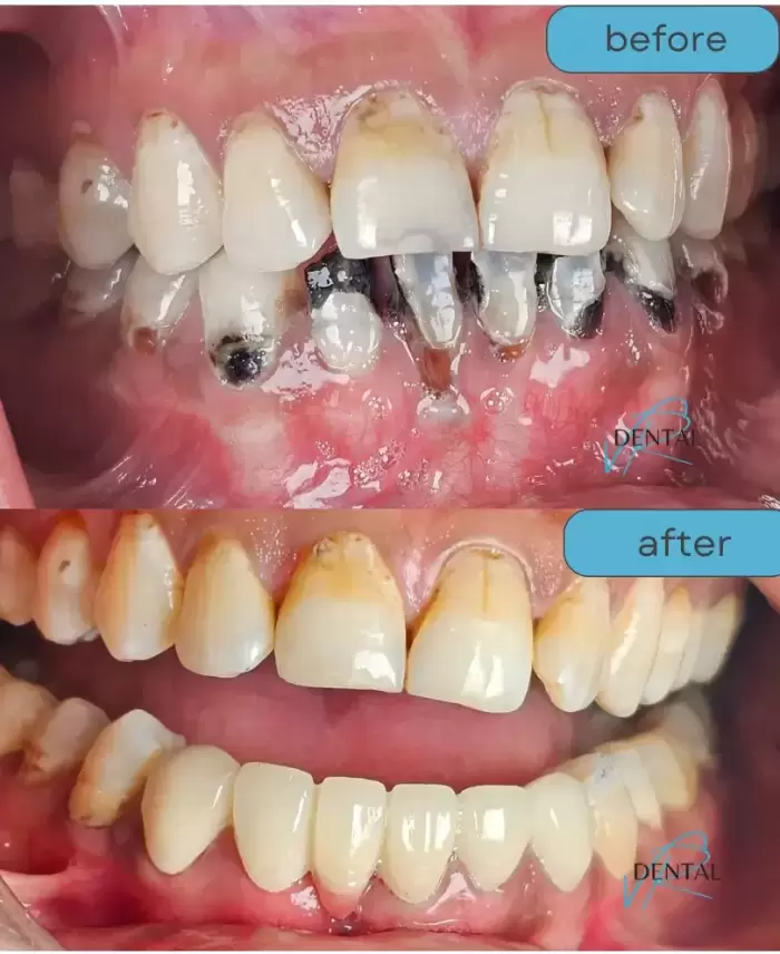 zirconia crown cost in kukatpally