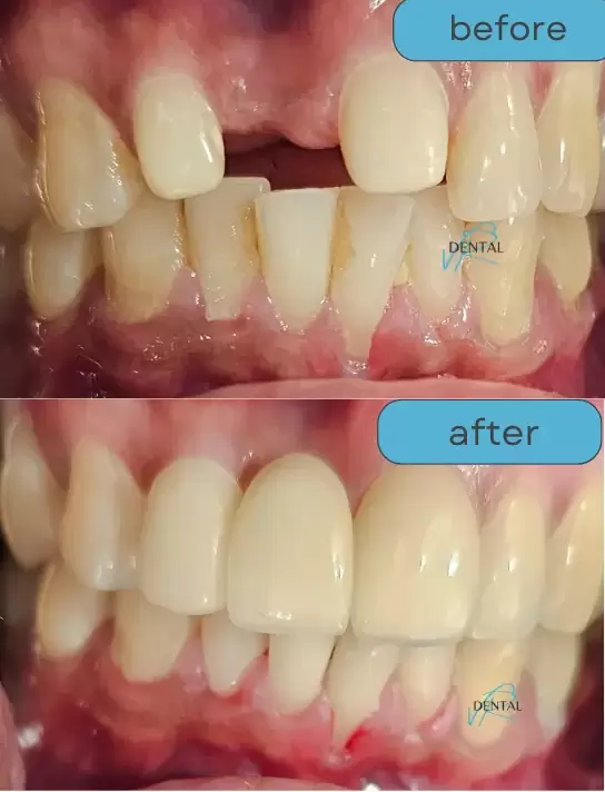 Zirconium crowns