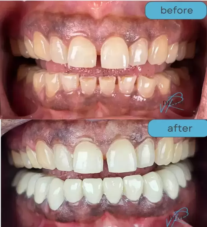 zirconia crown bridge