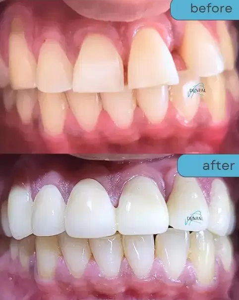 Zirconia crowns cost in Kukatpally