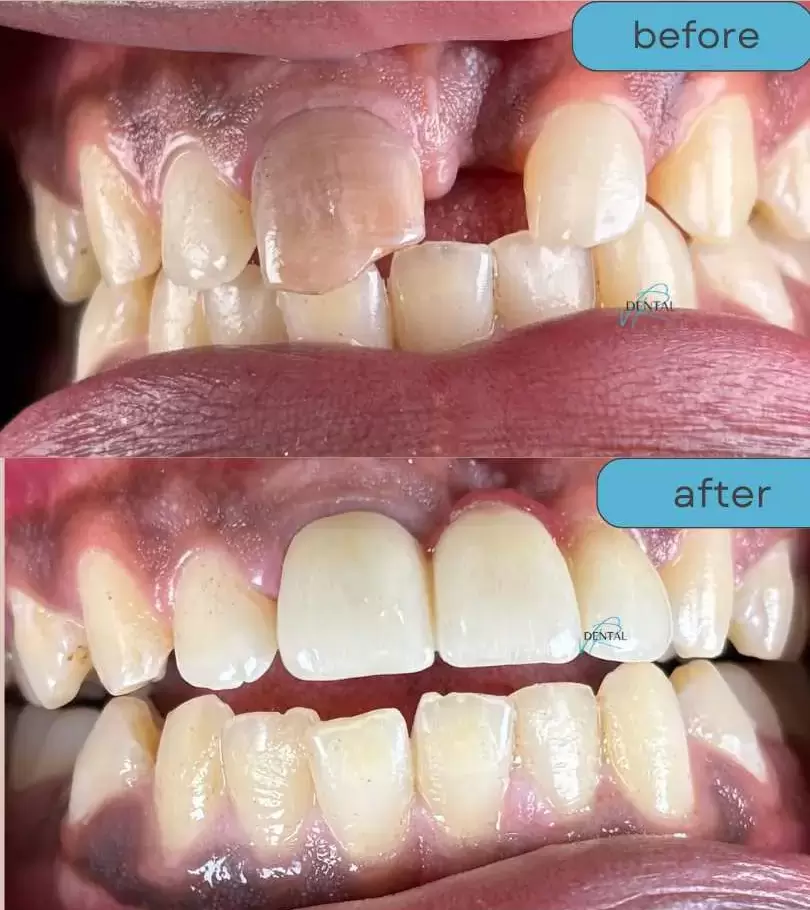 Zirconia crowns cost in Hyderabad